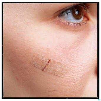 Nexcare 3m steri-strip sut.cut.ad.beige 6mmx75mm 6