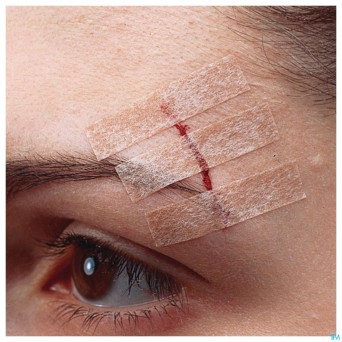 Nexcare 3m steri-strip sut.cut.ad.beige 6mmx75mm 6