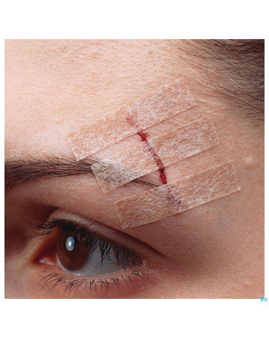 Nexcare 3m steri-strip sut.cut.ad.beige 6mmx75mm 6