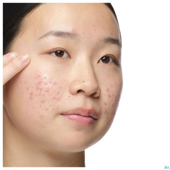 The ordinary aloe 2% + nag 2% solution 30ml